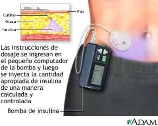 bomba insulina (Adam)